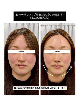 クレール 小山店(CLAIR)/【二重あご・むくみ改善】