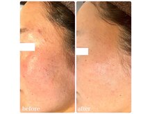 ラヴィアンローズ 岐阜本店(La vie en Rose)の雰囲気（イロンハーブピーリング(6回施術)）