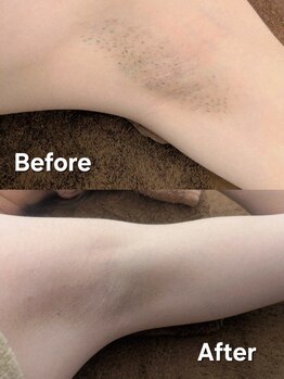 ボンド(BOND)/【脱毛サロン】ワキ脱毛