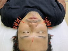皇漢堂鍼灸療院/男性こそ美容鍼を！