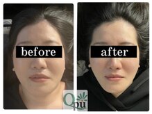 キュープ 小倉店(Qpu)/通常コース４回での変化