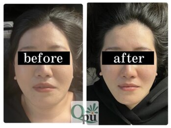 キュープ 小倉店(Qpu)/通常コース4回での変化