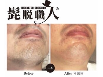 ナーズ(NAZ)/ヒゲ脱毛