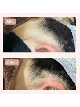 リードエピア(LEADepiA)/うなじ脱毛大人気♪