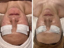 アイラブワン 大和 南林間店(eye love one)/光フォト＋ララピール【毛穴】