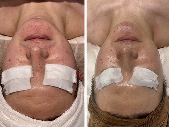 アイラブワン 大和 南林間店(eye love one)/光フォト+ララピール【毛穴】