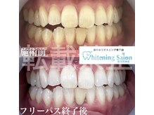 ホワイトニングサロン 福岡天神店/ホワイトニング