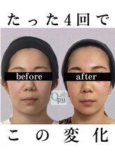 小顔矯正専門サロン キュープ 茨城つくば店(Qpu)&nbsp;小顔矯正 リンパケア