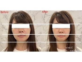 プレミドール(PREMIDOLL)/次世代☆小顔矯正