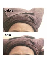 ブランシェ 富山店 × 椿/シワ・たるみケア　お客様