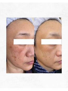 アルル 甲賀(ARuru)/シミの症例