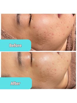 ティンクルホワイト 上尾店/水素水×毛穴洗浄/肌質改善