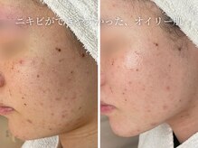 ハナコ 下通店(HANAKO)/【ニキビ殺菌＋脱毛効果】