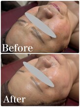 ルタンリッシュ ハナレ(Lutan Riche 花麗)/当店のシミケアはシミもたるみも