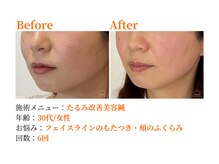 シルエラバレ(CiruelaValle)/Before After