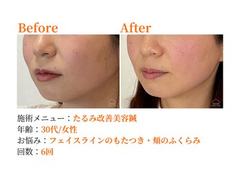 シルエラバレ(CiruelaValle)/Before After