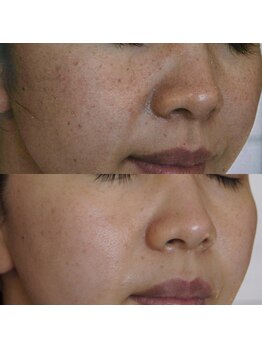 トラット エステアンドアイズ(tratto)/30代　お客様症例写真