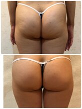 カロン(Kalon)/セル凹凸ケア