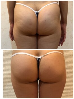 カロン(Kalon)/セル凹凸ケア