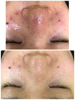 アンジェロ/【ニキビケア】肌育プログラム