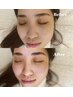 【一番人気♪眉毛と素肌に艶を】HBL×韓国式剥けないハーブピーリング14500円