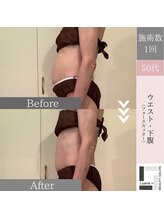 ルアナ プラス(Luana＋)/痩身/1回施術
