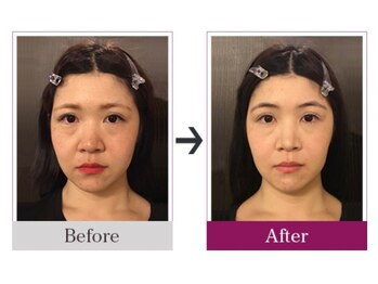 ビコツゼロ 心斎橋(BIKOTSU ZERO)/小顔・目の高さ・むくみ