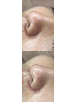 ベルティーク(BELTHEQUE)/肌管理/ララピール/ピーリング