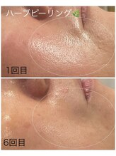 グレース(GRACE)/ハーブピーリング＋毛穴洗浄