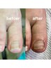 テープタイプの巻き爪矯正！1本のみ