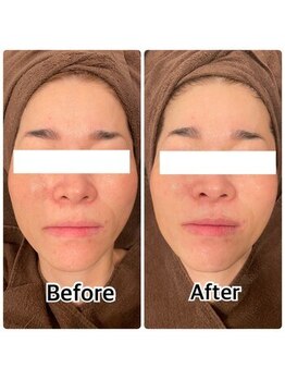 ラブームココ(LaBoom CoCo)/VOSで肌質改善★