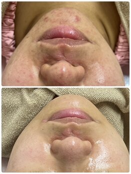 キュライム カブール町田店/美肌へ