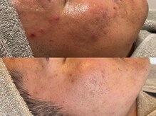 ピブ(PIBU)/男性ニキビ/ハーブピーリング