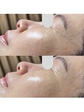 ウェリナベル(WelinaBelle)/ダクトピール：再生型ピーリング