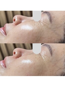 ウェリナベル(WelinaBelle)/ダクトピール：再生型ピーリング