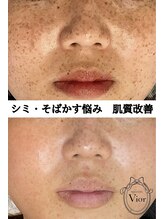 ヴィオール 名古屋栄店(VIOR) 色素改善 シミケア