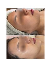 ウィズ(with)/REVIハーブピーリング