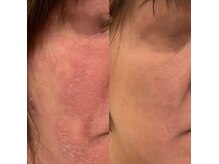 サロンド ララ(Salon de lala)の雰囲気（今までサロンケアを諦めていた敏感肌の方でもお任せください!!）