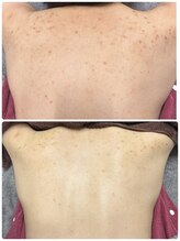 チュチュ(TUTU)/背中