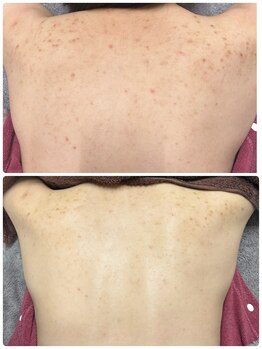 チュチュ(TUTU)/背中