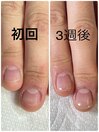 自爪育成
