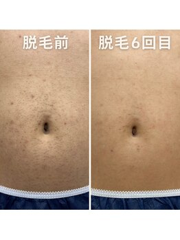 クイーン 熱海店(Queen)/男性のお腹のムダ毛もスッキリ