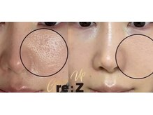 ラビュー(Lavyou)/大人気RE:Zでの1回施術後