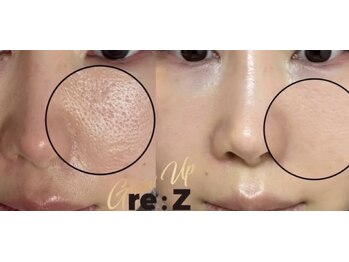 ラビュー(Lavyou)/大人気RE:Zでの1回施術後