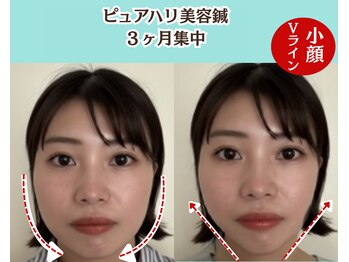 ピュアハリ/沖縄美容鍼 効果