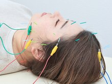 美容鍼です！目がパッチリ、お顔周りもスッキリしますよ。