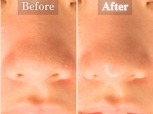 ボーンオム(Born Homme)/毛穴洗浄＋美容液導入：20代女性