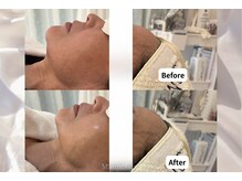 マウム(Maum)の雰囲気（乾燥肌・お肌の土台を整えるには水玉リフティング◎）