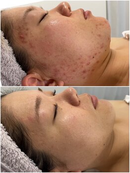 ユニ(uni.)/ショートカットピーリング