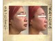 サンテボーテ(Sante Beaute)の写真/二重あご・たるみ・ほうれい線にさよなら！もたつき・むくみ解消◎すっきりフェイスラインで若々しく！